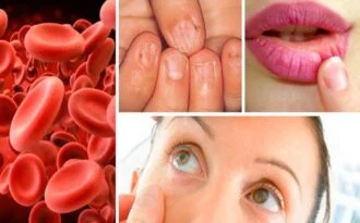 imagen donde se muestran ilustrados los síntomas de la anemia