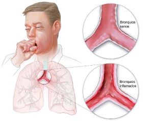 imagen de señor tosiendo y comparación de bronquios inflamados y sanos